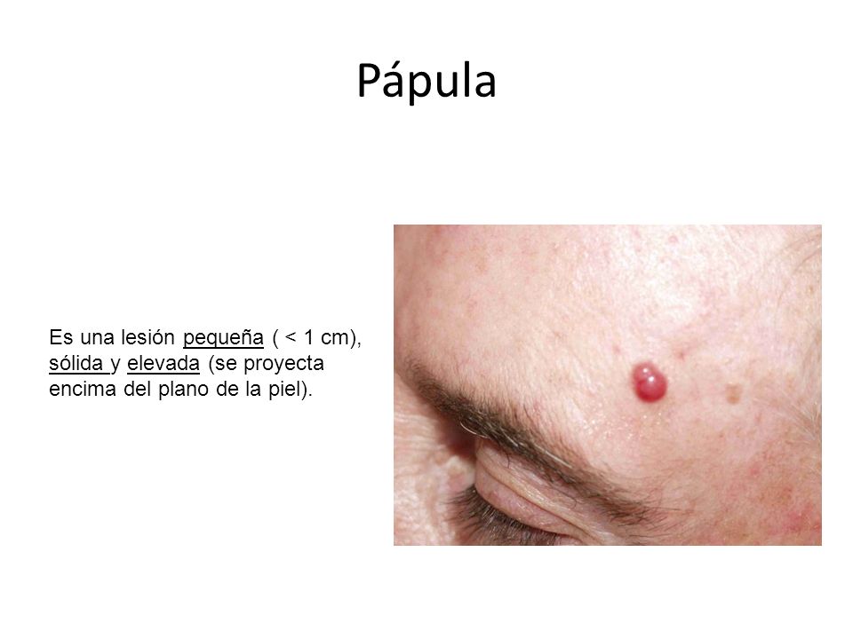 Pápula Es una lesión pequeña ( < 1 cm), sólida y elevada (se proyecta encima del plano de la piel).