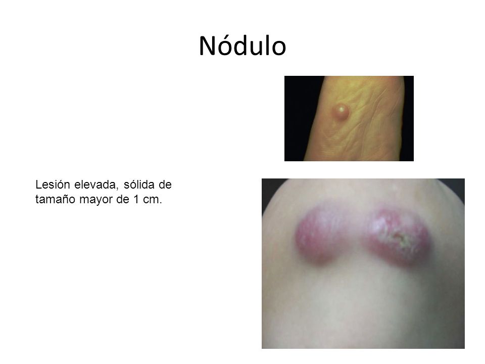 Nódulo Lesión elevada, sólida de tamaño mayor de 1 cm.