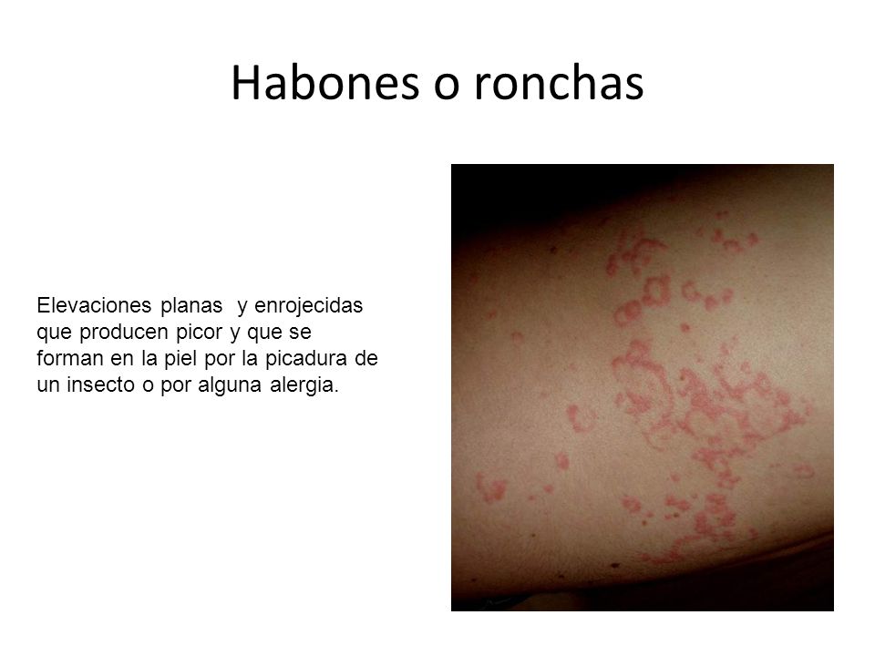 Habones o ronchas Elevaciones planas y enrojecidas que producen picor y que se forman en la piel por la picadura de un insecto o por alguna alergia.