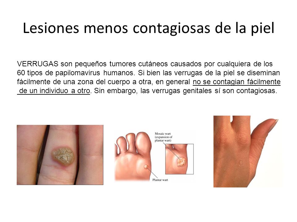 Lesiones menos contagiosas de la piel