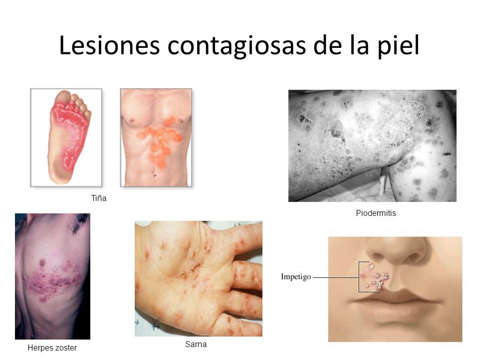 Lesiones contagiosas de la piel
