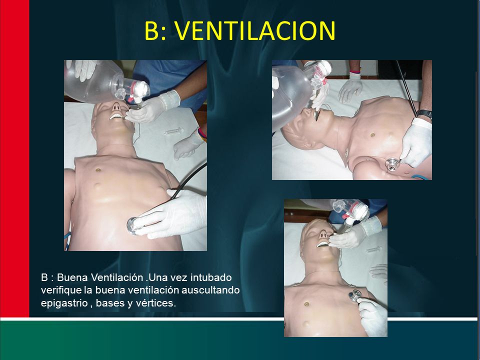 B: VENTILACION B : Buena Ventilación .Una vez intubado verifique la buena ventilación auscultando epigastrio , bases y vértices.