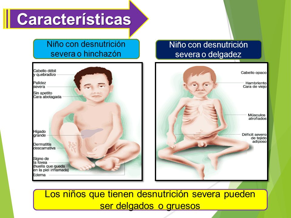 Características Niño con desnutrición severa o hinchazón. Niño con desnutrición severa o delgadez.