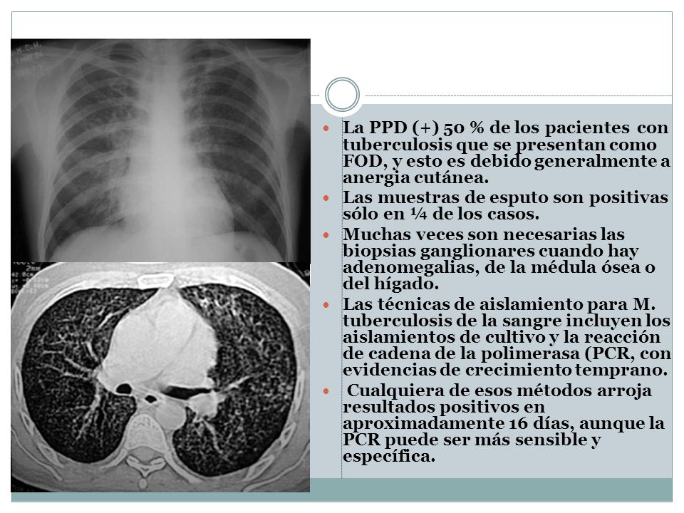 La PPD (+) 50 % de los pacientes con tuberculosis que se presentan como FOD, y esto es debido generalmente a anergia cutánea.