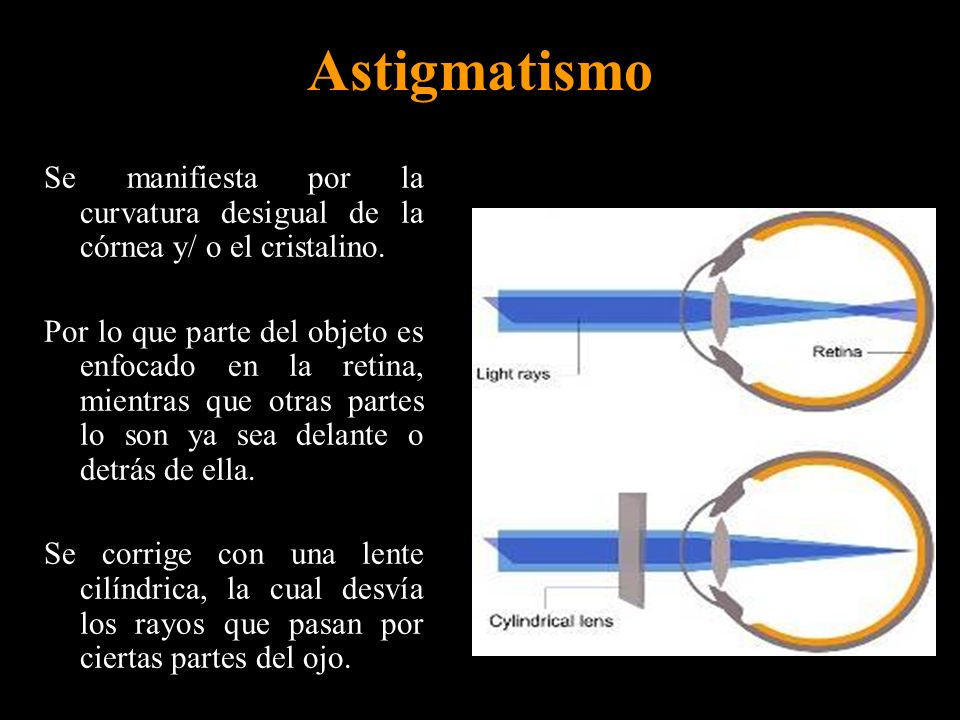 Astigmatismo Se manifiesta por la curvatura desigual de la córnea y/ o el cristalino.