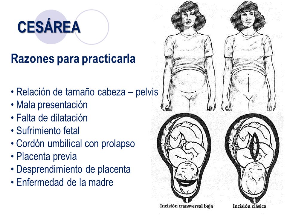 CESÁREA Razones para practicarla Relación de tamaño cabeza – pelvis