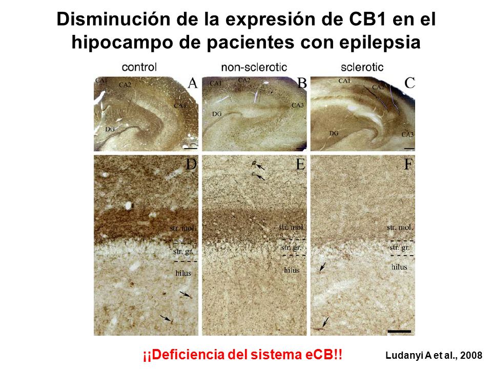 Disminución de la expresión de CB1 en el hipocampo de pacientes con epilepsia