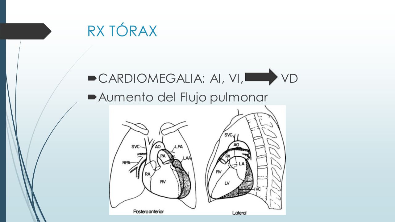 RX TÓRAX CARDIOMEGALIA: AI, VI, VD Aumento del Flujo pulmonar