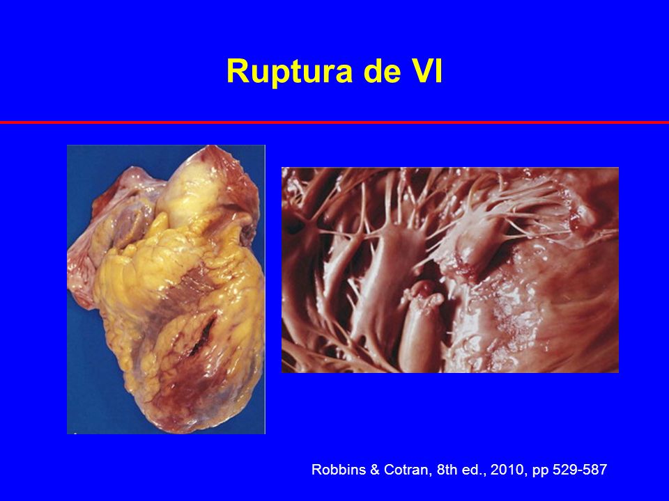 Ruptura de VI Robbins & Cotran, 8th ed., 2010, pp