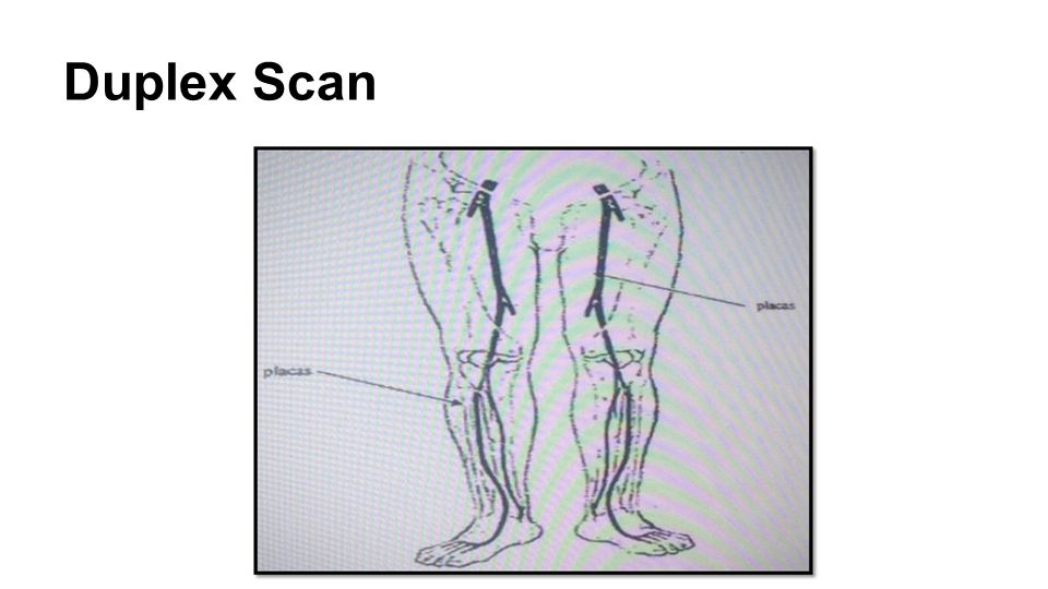 Duplex Scan Presencia de placas ateromatosas calcificadas en toso los segmentos examinados, sin lesiones estenóticas significativas hemodinámicamente.