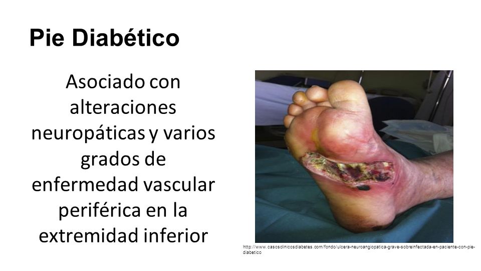 Pie Diabético Asociado con alteraciones neuropáticas y varios grados de enfermedad vascular periférica en la extremidad inferior.