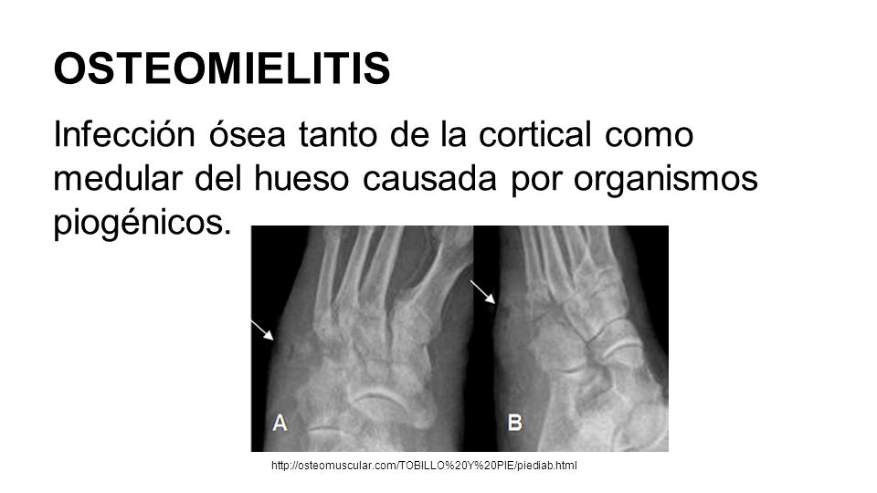 OSTEOMIELITIS Infección ósea tanto de la cortical como medular del hueso causada por organismos piogénicos.