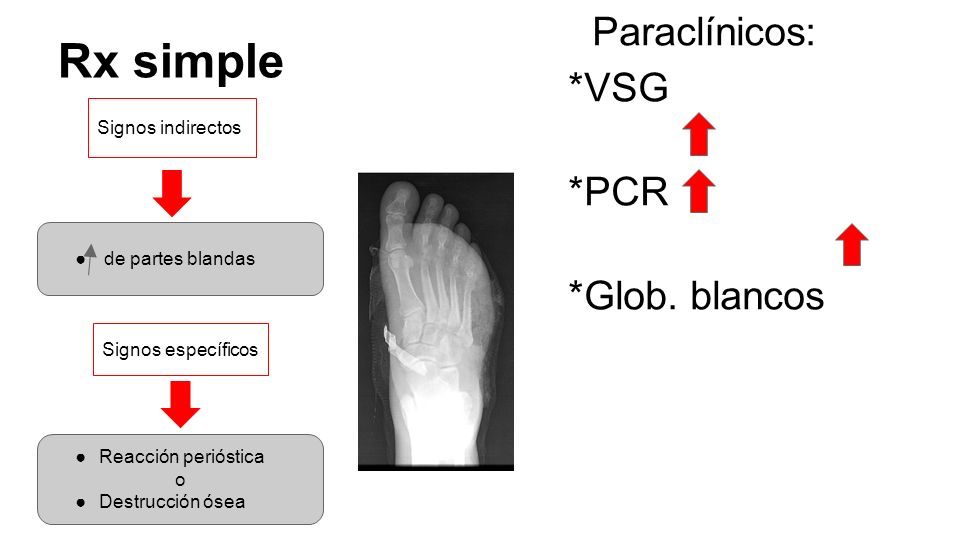 Rx simple Paraclínicos: *VSG *PCR *Glob. blancos Signos indirectos
