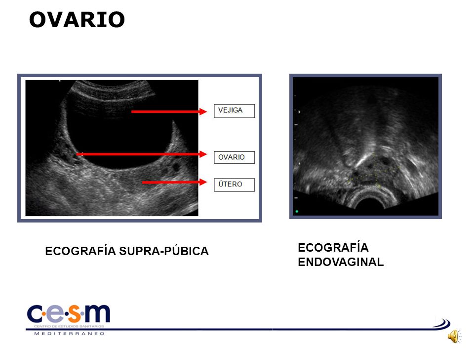 OVARIO ECOGRAFÍA ENDOVAGINAL ECOGRAFÍA SUPRA-PÚBICA