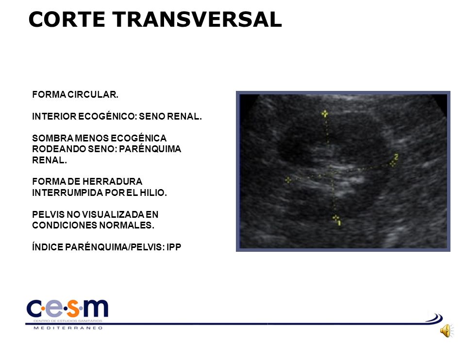 CORTE TRANSVERSAL FORMA CIRCULAR. INTERIOR ECOGÉNICO: SENO RENAL.