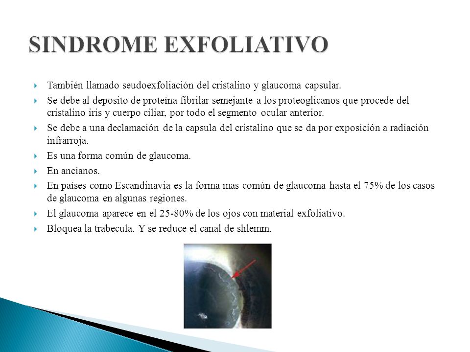 SINDROME EXFOLIATIVO También llamado seudoexfoliación del cristalino y glaucoma capsular.