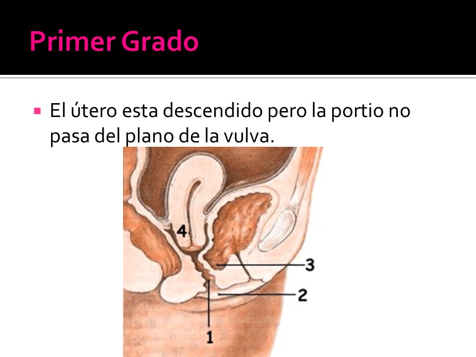 Primer Grado El útero esta descendido pero la portio no pasa del plano de la vulva.