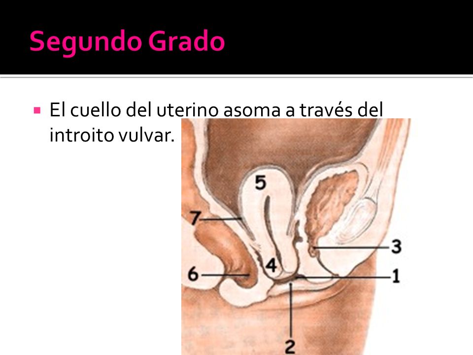 Segundo Grado El cuello del uterino asoma a través del introito vulvar.