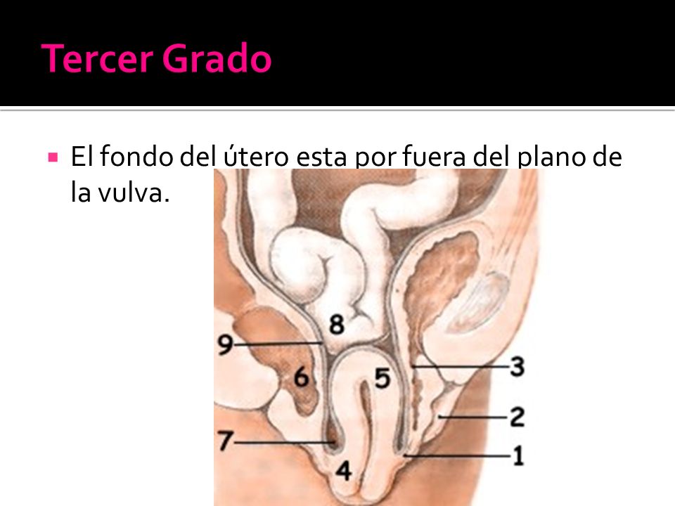 Tercer Grado El fondo del útero esta por fuera del plano de la vulva.