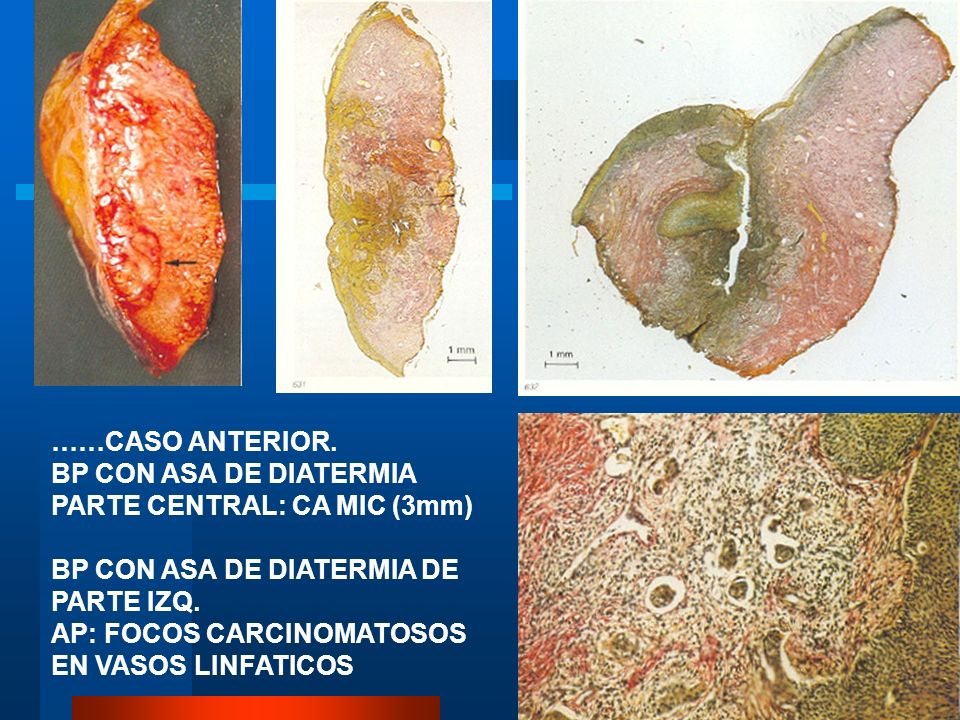 PARTE CENTRAL: CA MIC (3mm) BP CON ASA DE DIATERMIA DE PARTE IZQ.
