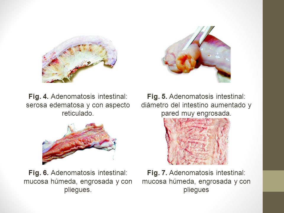 Fig. 4. Adenomatosis intestinal: serosa edematosa y con aspecto reticulado.