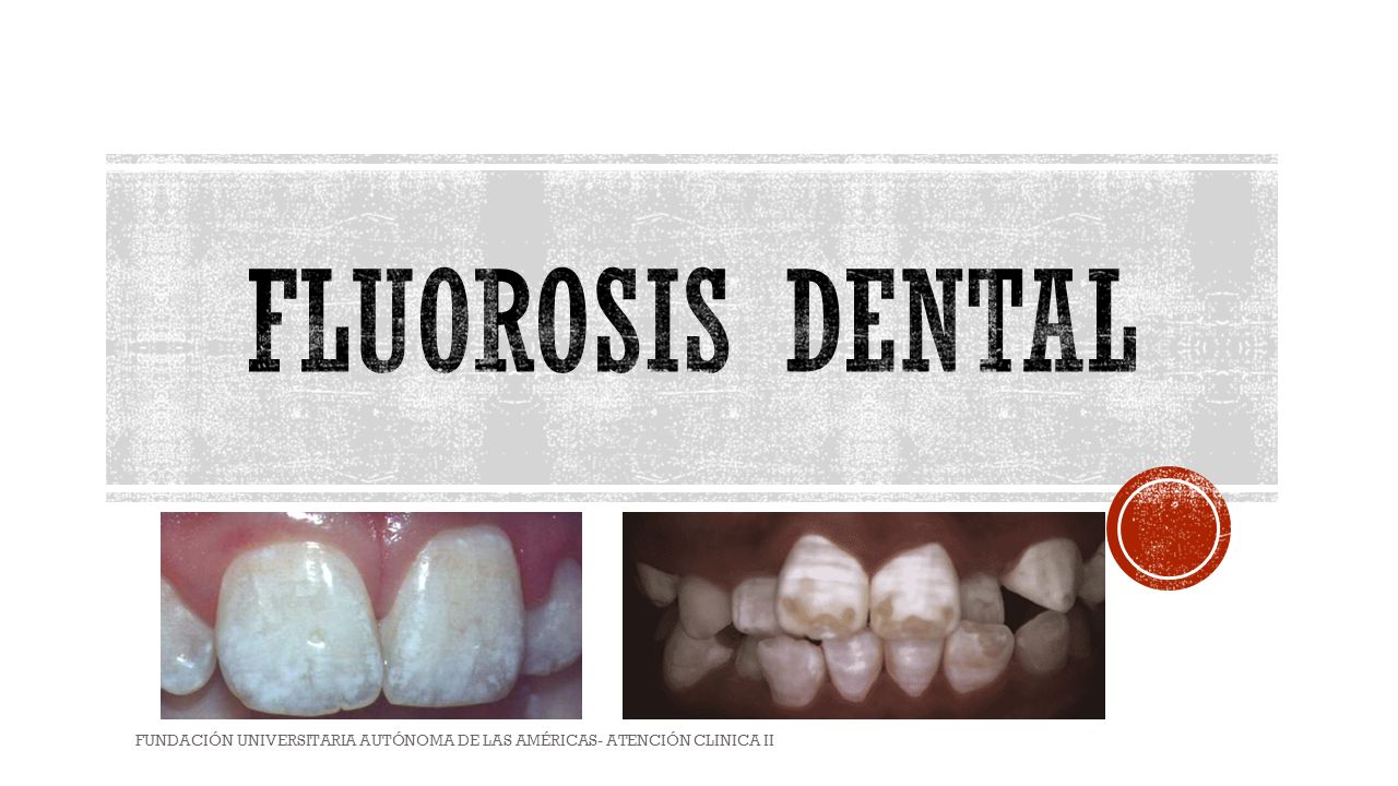 FLUOROSIS DENTAL FUNDACIÓN UNIVERSITARIA AUTÓNOMA DE LAS AMÉRICAS- ATENCIÓN CLINICA II