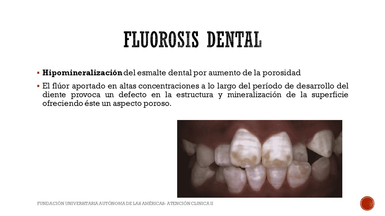 FLUOROSIS DENTAL Hipomineralización del esmalte dental por aumento de la porosidad.
