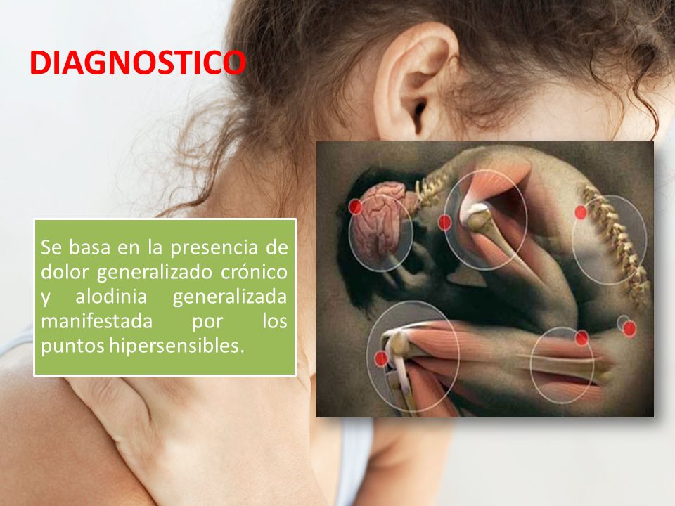 DIAGNOSTICO Se basa en la presencia de dolor generalizado crónico y alodinia generalizada manifestada por los puntos hipersensibles.