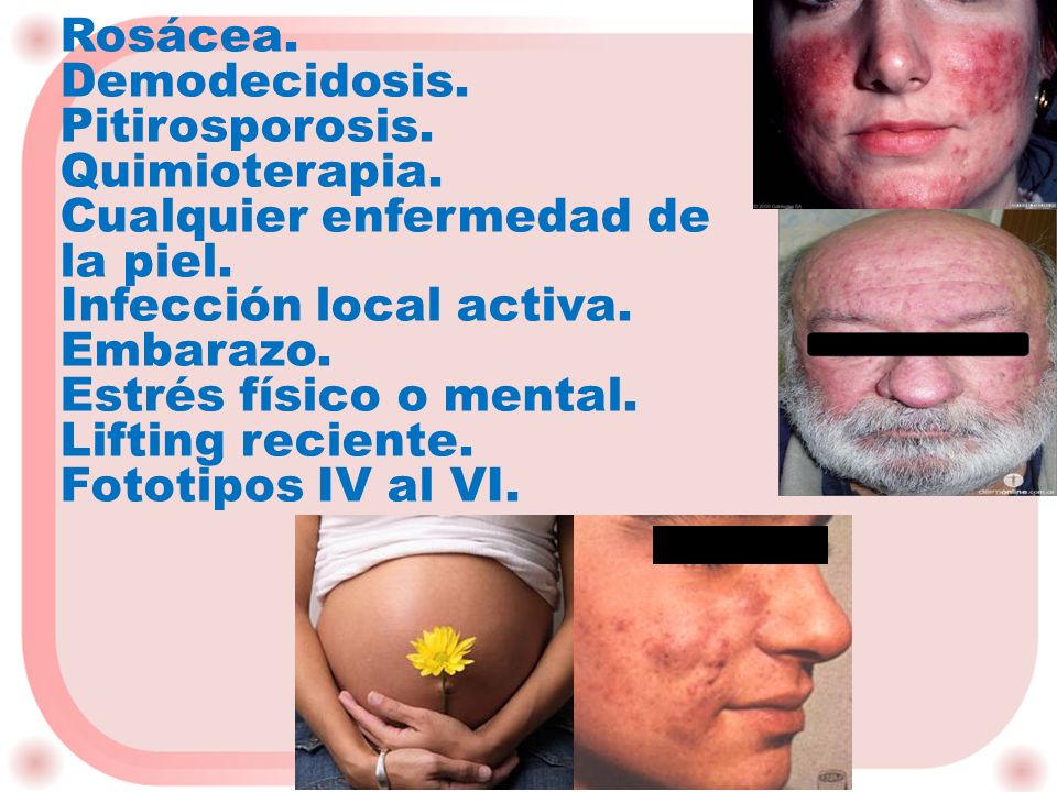 Rosácea. Demodecidosis. Pitirosporosis. Quimioterapia. Cualquier enfermedad de la piel. Infección local activa.