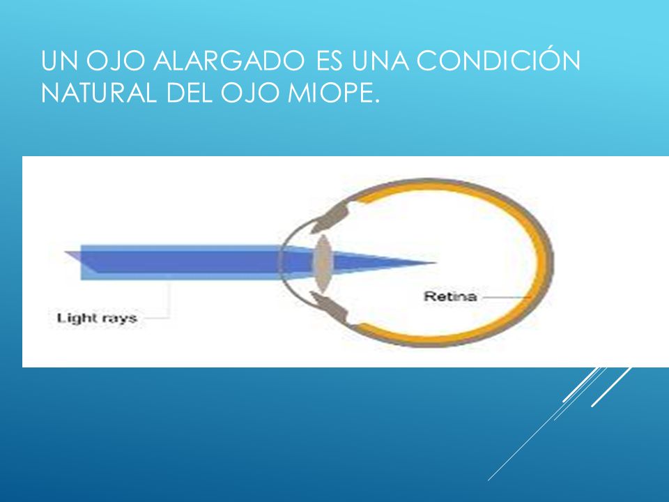 Un ojo alargado es una condición natural del ojo miope.