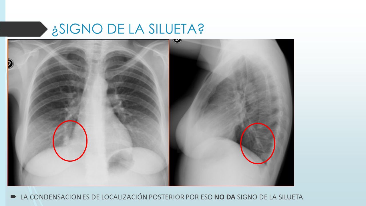 ¿SIGNO DE LA SILUETA LA CONDENSACION ES DE LOCALIZACION POSTERIOR POR ESO NO DA SIGNO DE LA SILUETA.