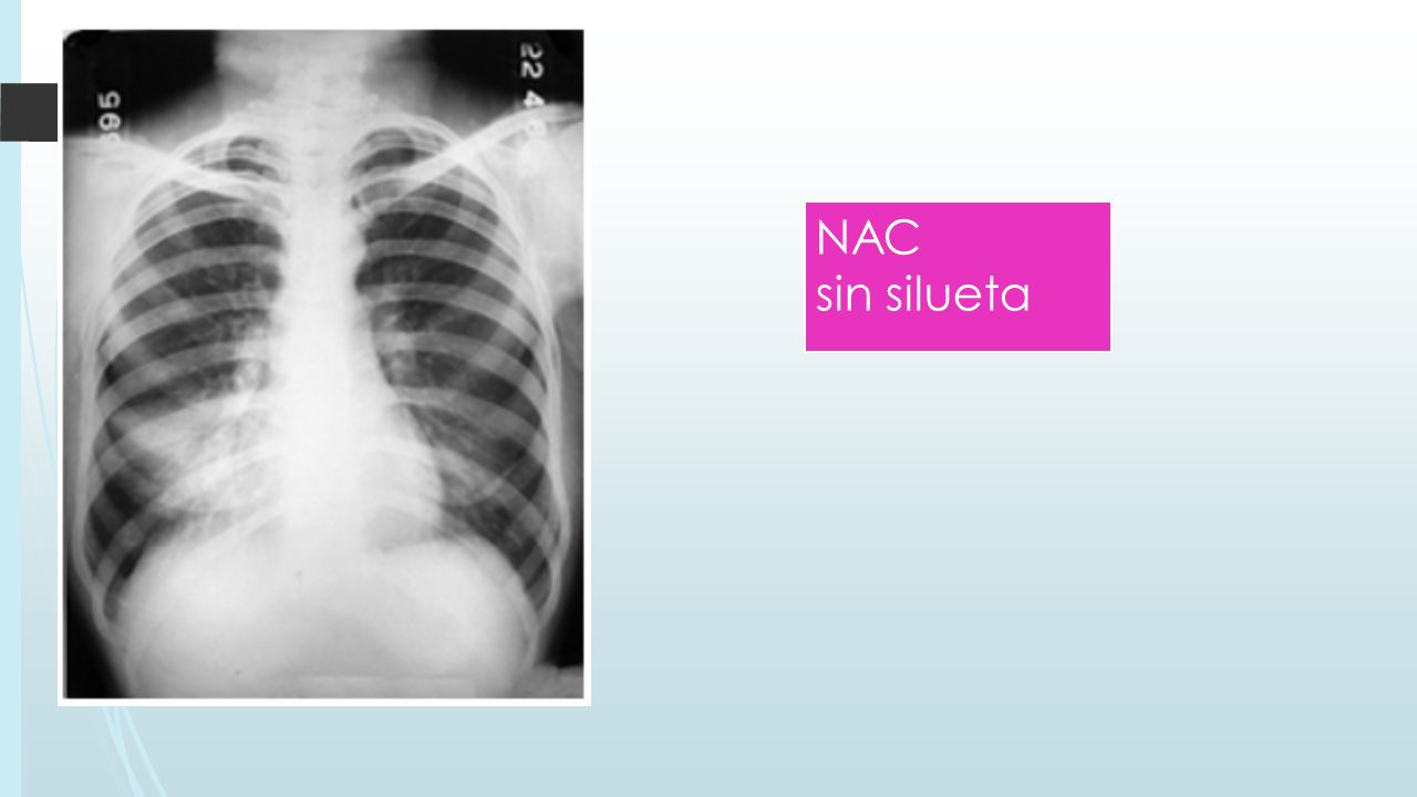 NAC sin silueta ADEMAS SE PUEDE EVALUAR EL SIGNO DE LA SILUETA.