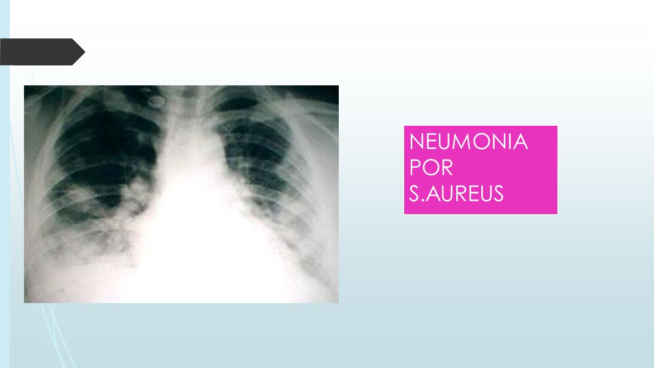 NEUMONIA POR S.AUREUS ADEMAS SE PUEDE EVALUAR EL SIGNO DE LA SILUETA.