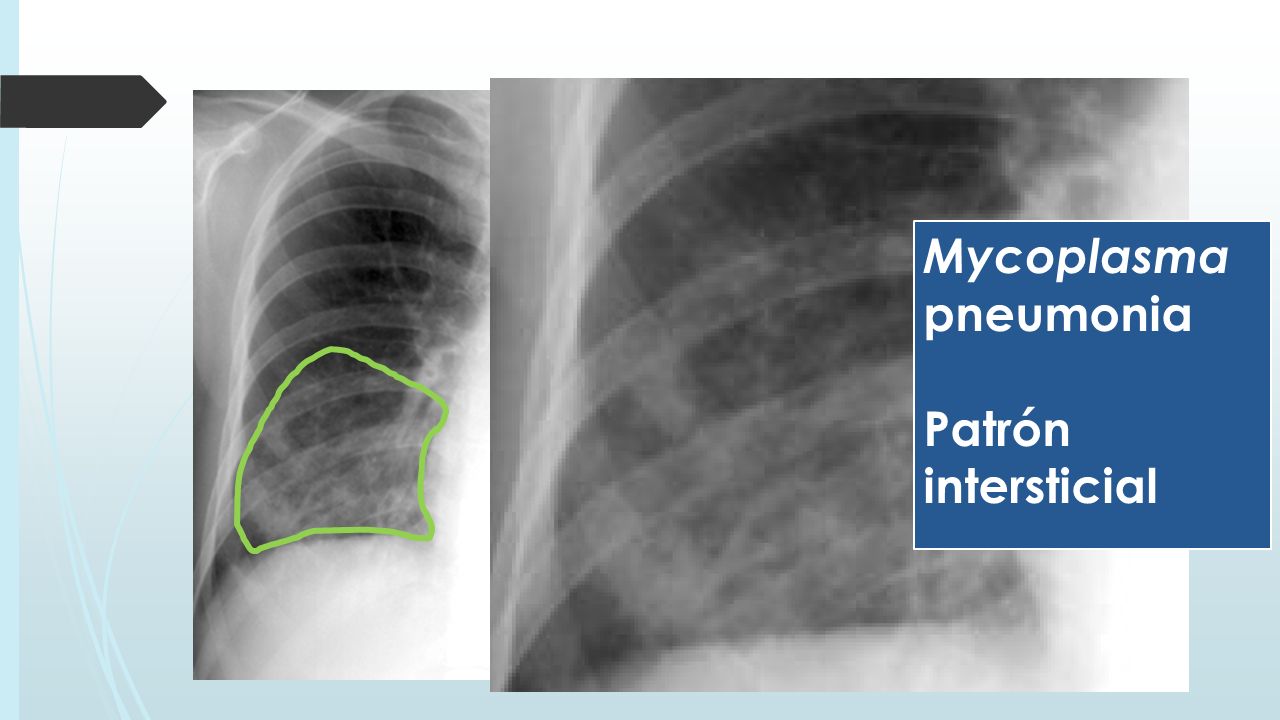 Mycoplasma pneumonia Patrón intersticial