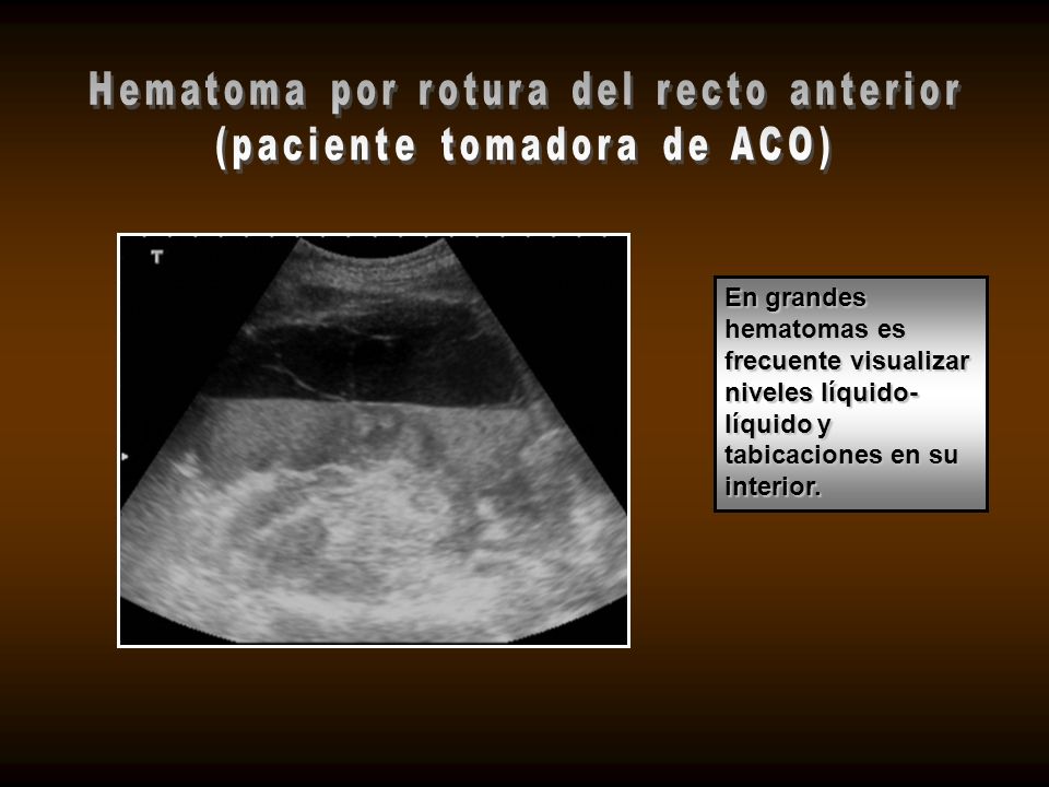Hematoma por rotura del recto anterior (paciente tomadora de ACO)