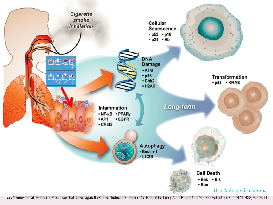 Molecular processes that drive cigarette smoke (CS)-induced epithelial cell fate of the lung. CS exposure induces inflammation, DNA damage ( incluye oxidacion y metilacion del AND, inestabilidad microsatelite del ADN, perdida de la heterozigosidad, ruptura de la cadena de AND) el daño al AND es por los ROS y RNS –reactive nitrogen species-, and autophagy that cause lung epithelial cells to undergo cell death, cellular senescence, and/or transformation.