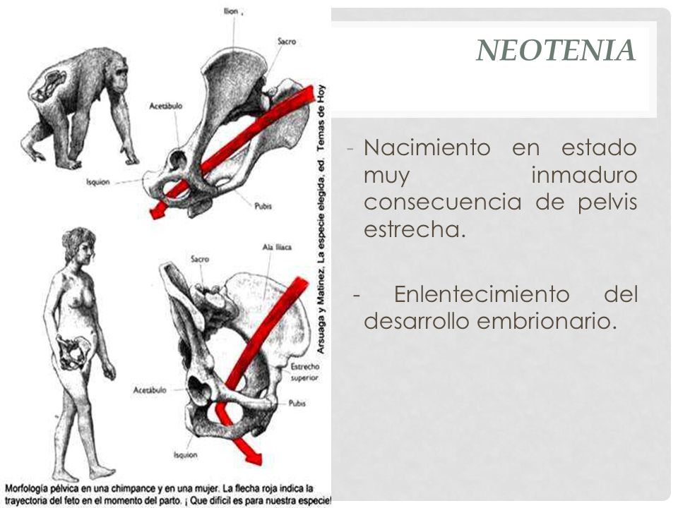 NEOTENIA+Nacimiento+en+estado+muy+inmaduro+consecuencia+de+pelvis+estrecha..jpg