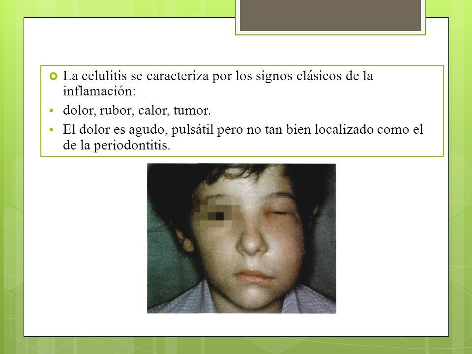 La celulitis se caracteriza por los signos clásicos de la inflamación: