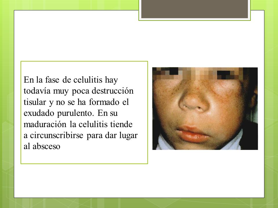 En la fase de celulitis hay todavía muy poca destrucción tisular y no se ha formado el exudado purulento. En su maduración la celulitis tiende