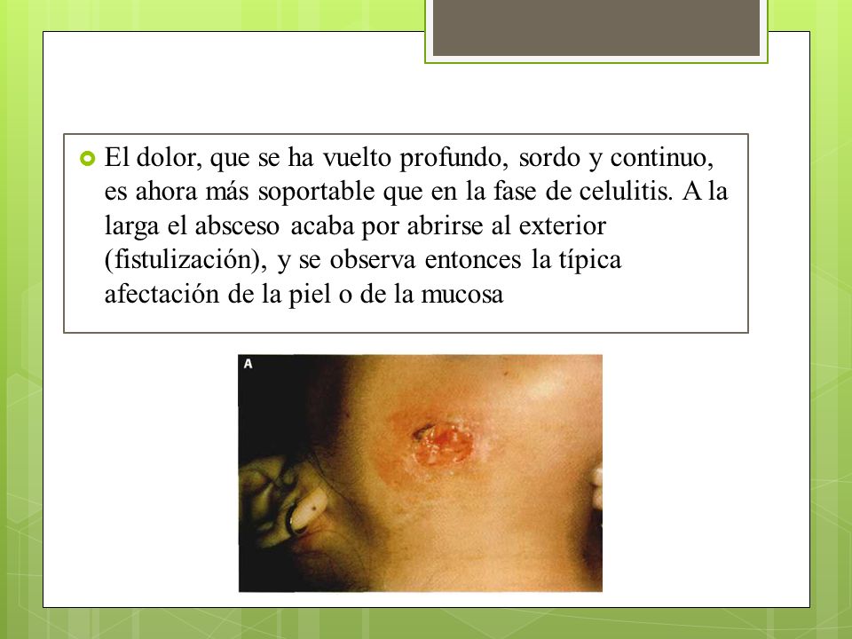 El dolor, que se ha vuelto profundo, sordo y continuo, es ahora más soportable que en la fase de celulitis.
