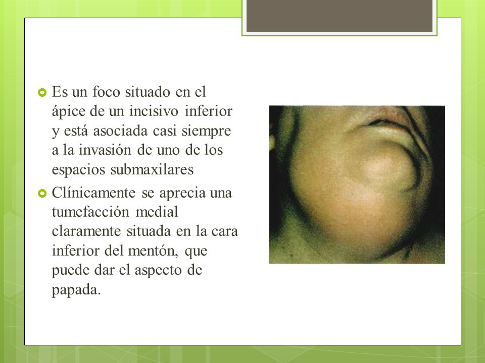 Es un foco situado en el ápice de un incisivo inferior y está asociada casi siempre a la invasión de uno de los espacios submaxilares
