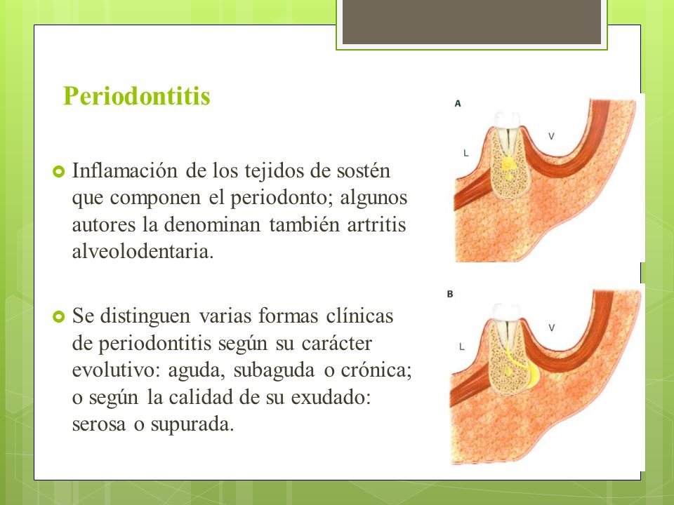 Periodontitis Inflamación de los tejidos de sostén que componen el periodonto; algunos autores la denominan también artritis alveolodentaria.
