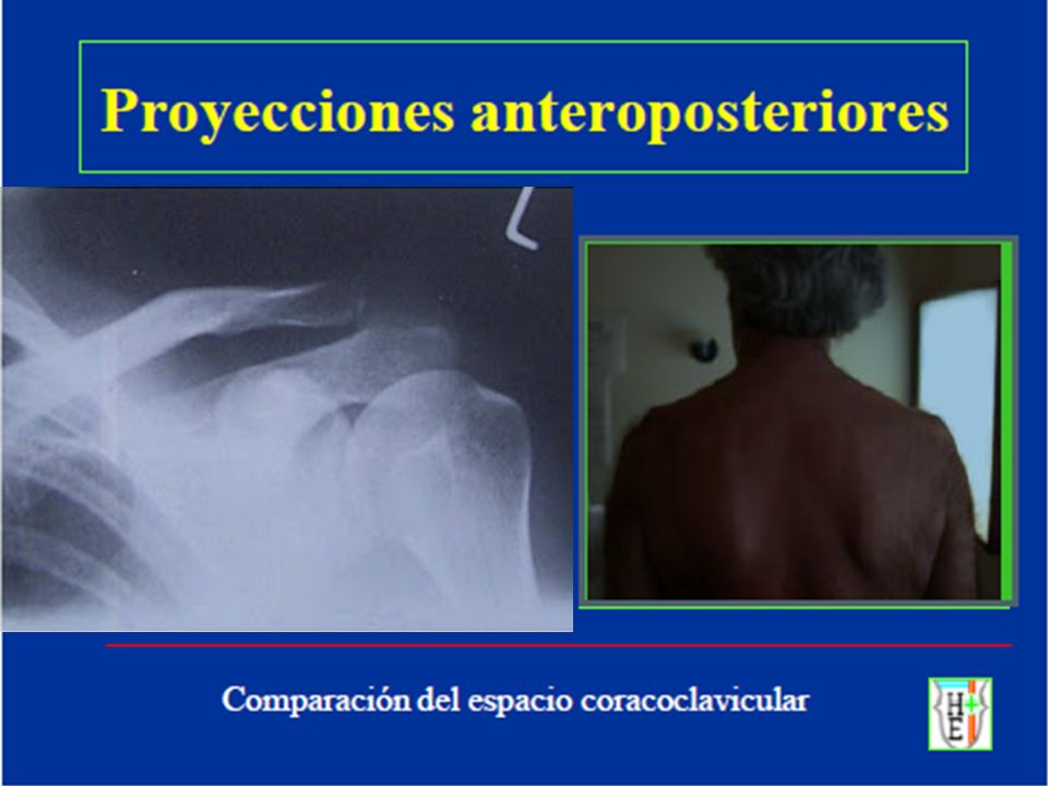 ARTICULACIONES ACROMIOCLAVICULARES PROYECCION AXIAL AP (METODO DE ALEXANDER) Alexander sugiere hacer ambas Ap y lateral en casos de que haiga una subluxacion o luxacion.