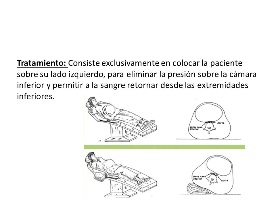 Tratamiento: Consiste exclusivamente en colocar la paciente sobre su lado izquierdo, para eliminar la presión sobre la cámara inferior y permitir a la sangre retornar desde las extremidades inferiores.