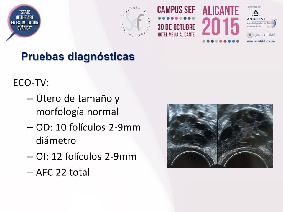 Pruebas diagnósticas ECO-TV: Útero de tamaño y morfología normal. OD: 10 folículos 2-9mm diámetro.