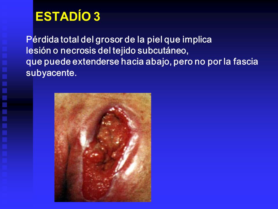 ESTADÍO 3 Pérdida total del grosor de la piel que implica