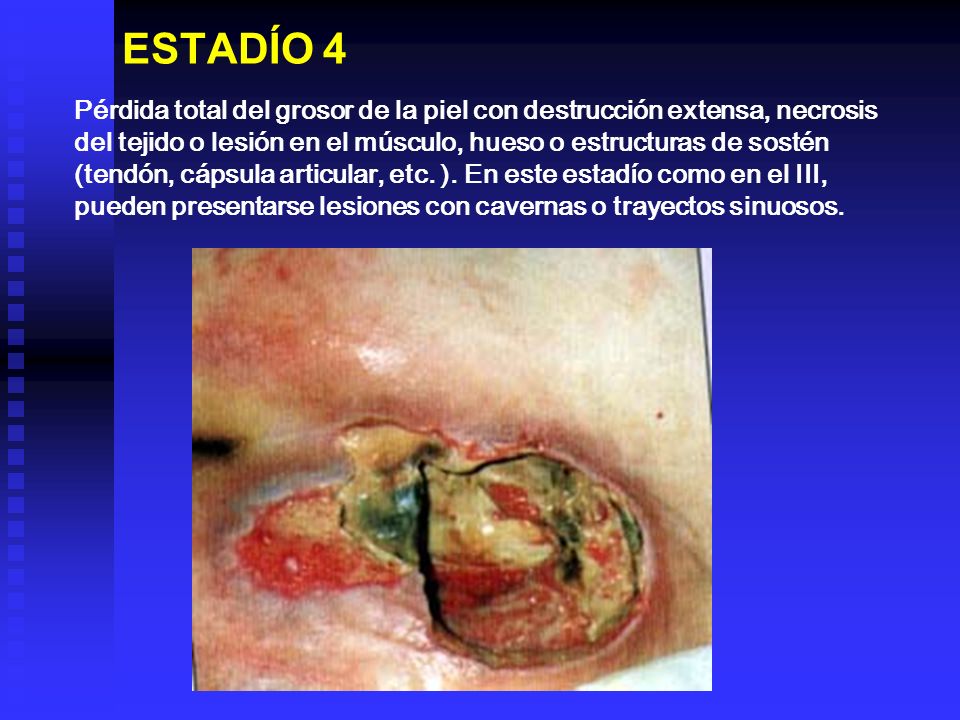 ESTADÍO 4 Pérdida total del grosor de la piel con destrucción extensa, necrosis. del tejido o lesión en el músculo, hueso o estructuras de sostén.