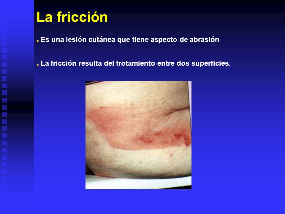 La fricción Es una lesión cutánea que tiene aspecto de abrasión