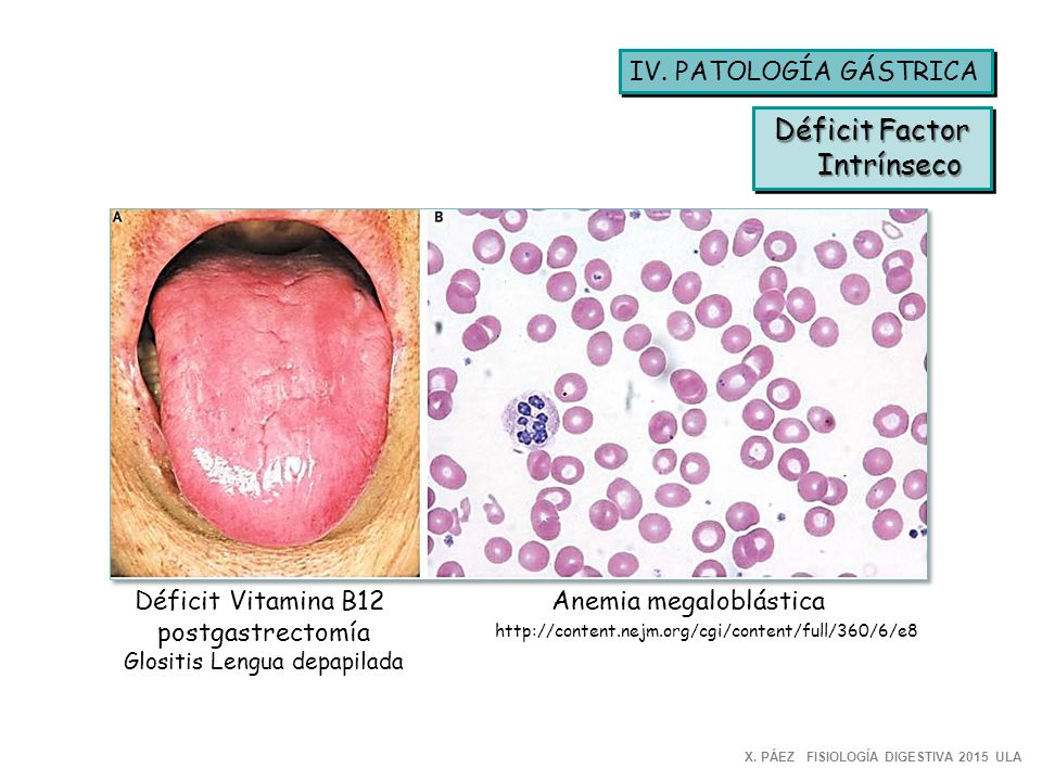 Déficit Factor Intrínseco IV. PATOLOGÍA GÁSTRICA Déficit Vitamina B12