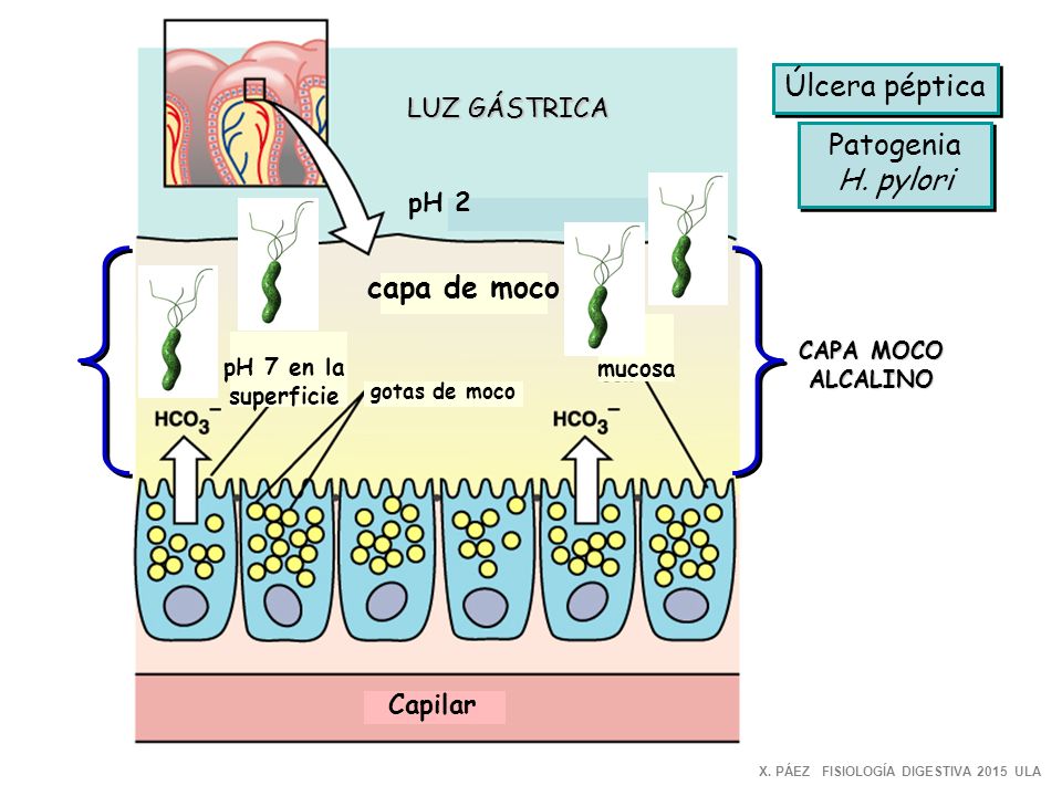 Úlcera péptica Patogenia H. pylori capa de moco LUZ GÁSTRICA pH 2
